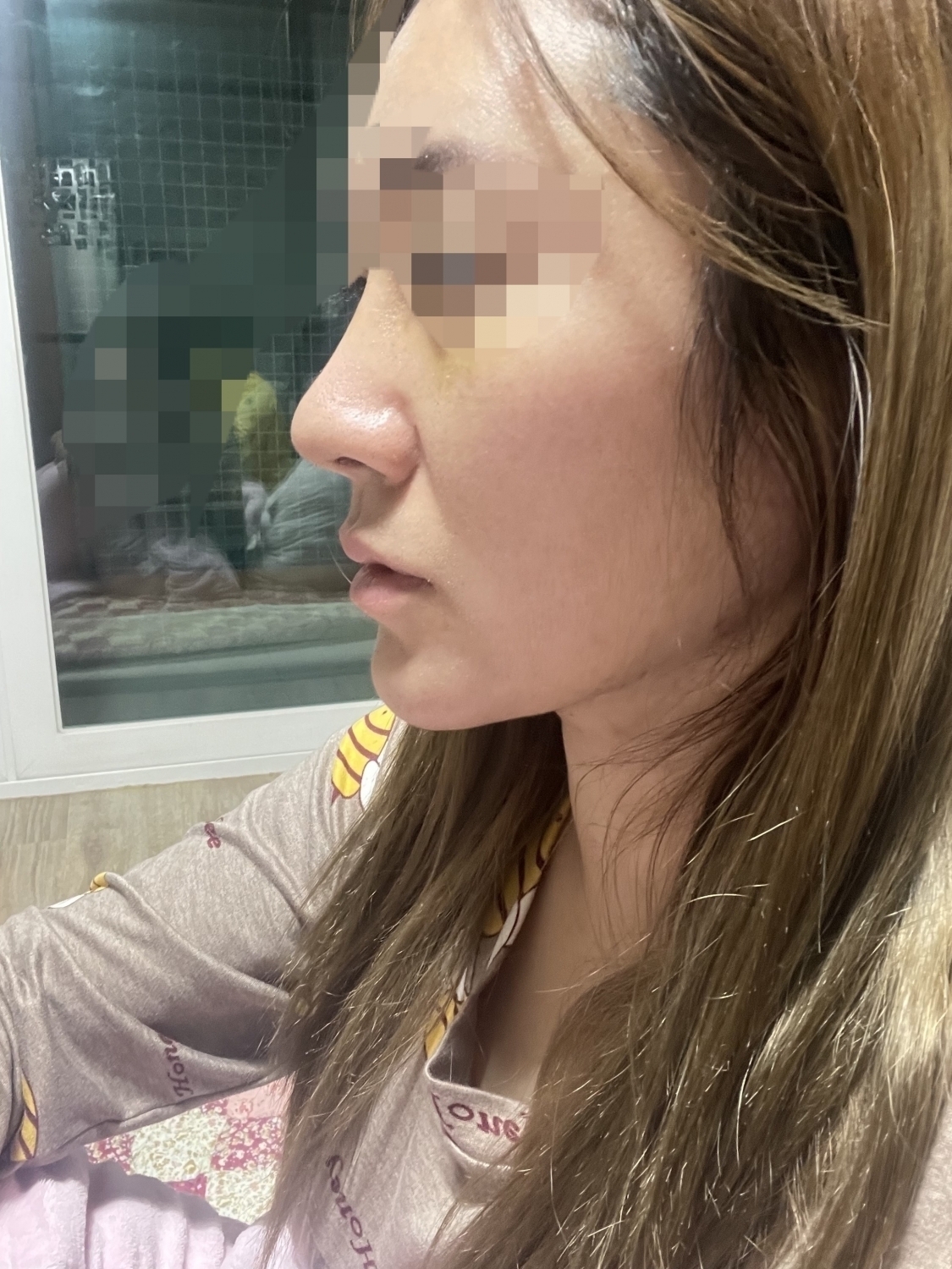 8일차 부목제거한날 