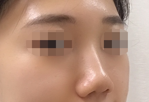 Nose Doubt: Review of “Nose Up” Bridge-Straightening Clip –  BeautyandtheCat's Beauty Blog