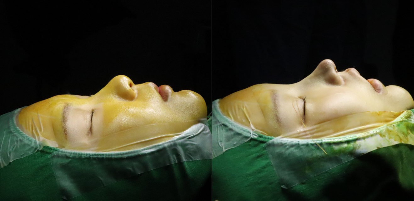 왼쪽이 수술 전 / 오른쪽이 수술 직후입니다! 이렇게 보니까 예전 코가 너무 짧고 뚱뚱한 코였는데 원장님이 예쁘게 더 올려주시고 들린코 아래로 잘 내려주셨어요