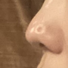 코제거, 코끝 패임