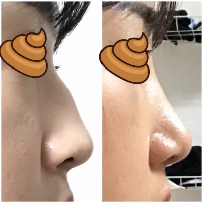 이비인후과에서 비개방 수술 망했습니당!