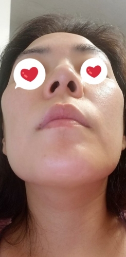 코 수술한지 11년... 재수술 생각중
