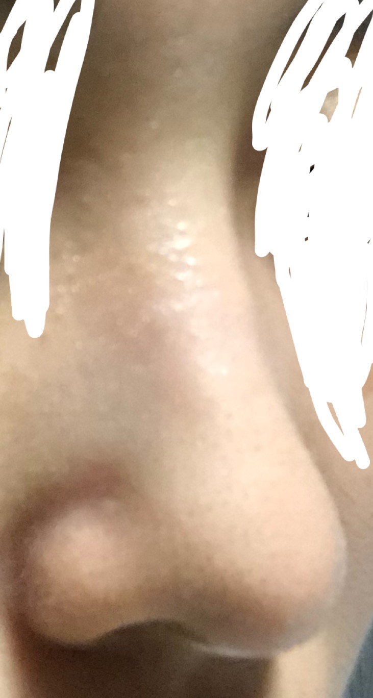 이비인후과 수술후기 이비인후과에서 수술후 재수술 생각중입니다 코성형 포럼 > 성예사” style=”width:100%” title=”이비인후과에서 수술후 재수술 생각중입니다 코성형 포럼 > 성예사”><figcaption>이비인후과에서 수술후 재수술 생각중입니다 코성형 포럼 > 성예사</figcaption></figure>
<figure><img decoding=
