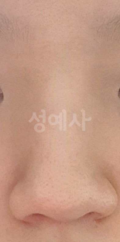 복코 넓은 코 성형 알아보고 있습니다. 복코 넓은 코 성형 알아보고 있습니다.