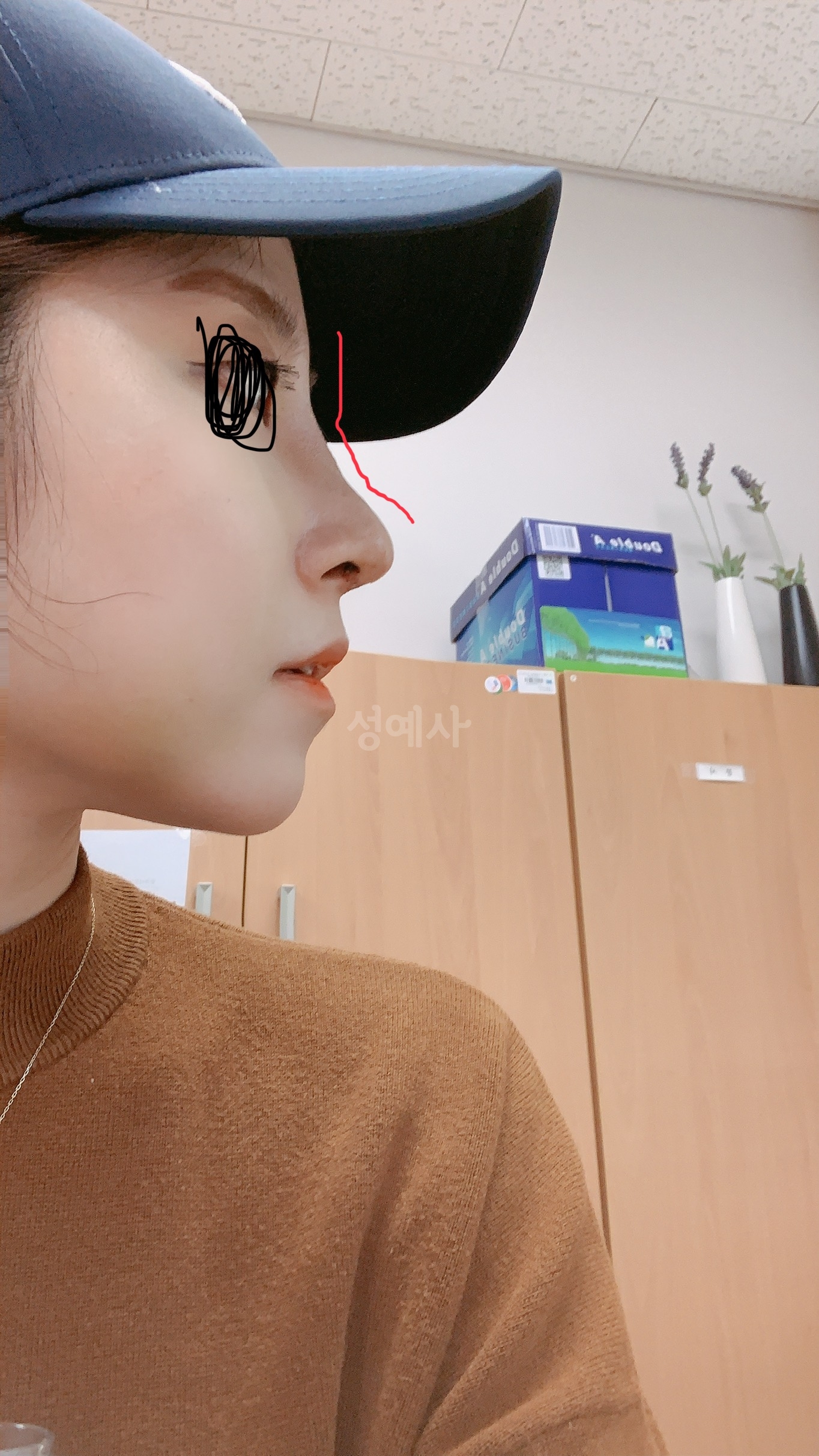 무보형 복비 성형 7