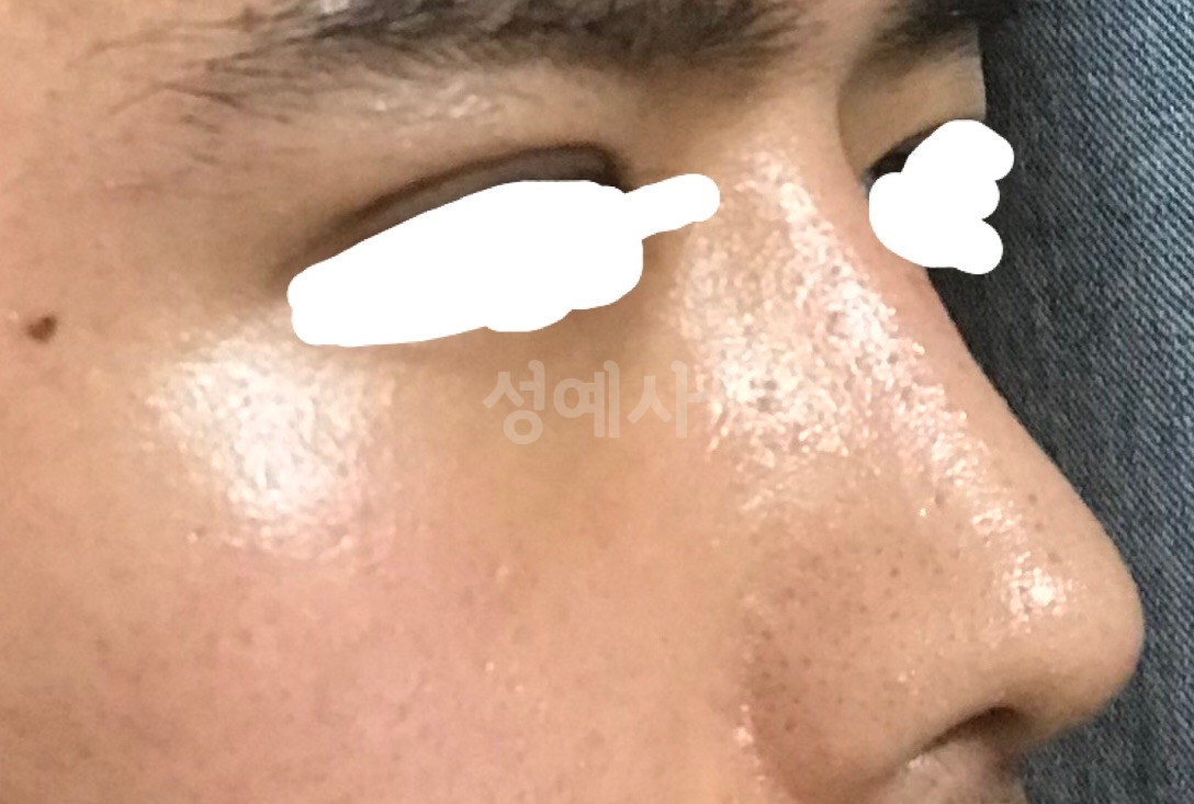 무보형 복비 성형 3