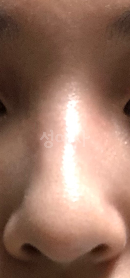남자 코 성형이요!! 이비인후과에서 수술후 재수술 생각중입니다 코성형 포럼 > 성예사” style=”width:100%” title=”이비인후과에서 수술후 재수술 생각중입니다 코성형 포럼 > 성예사”><figcaption>이비인후과에서 수술후 재수술 생각중입니다 코성형 포럼 > 성예사</figcaption></figure>
<figure><img decoding=