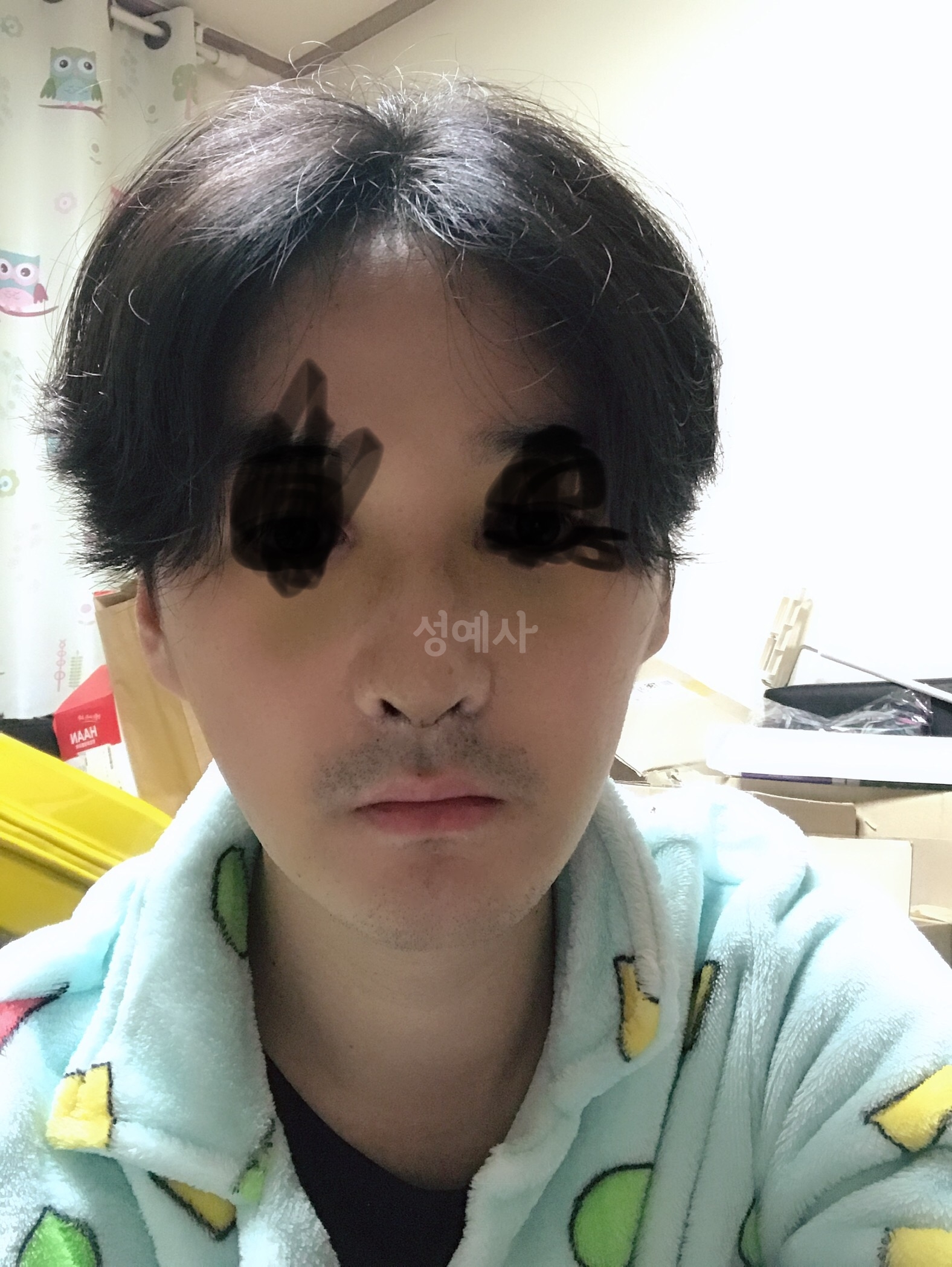 부천코수술 섬세하게 확인해서