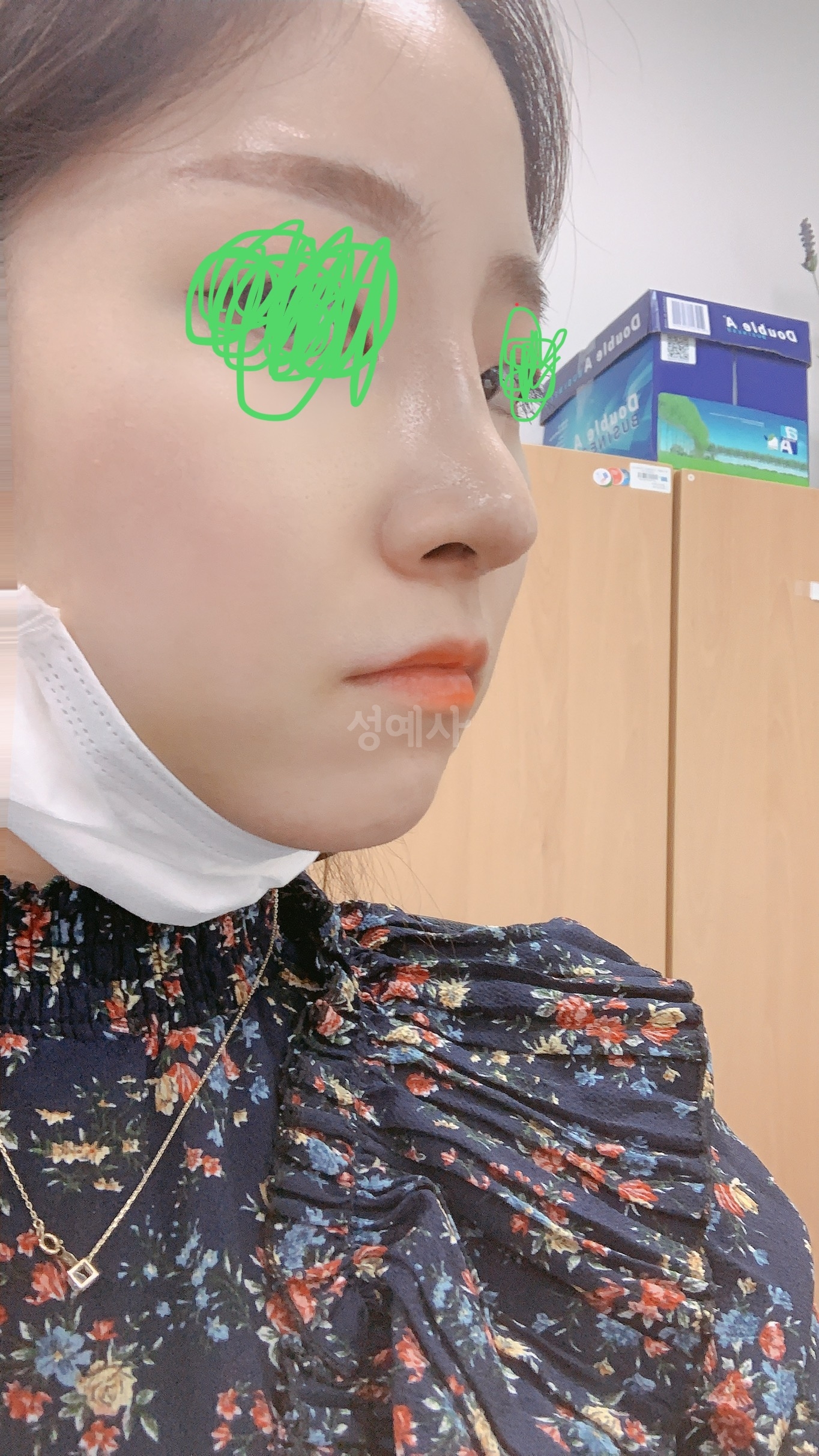 무보형 복비 성형 2