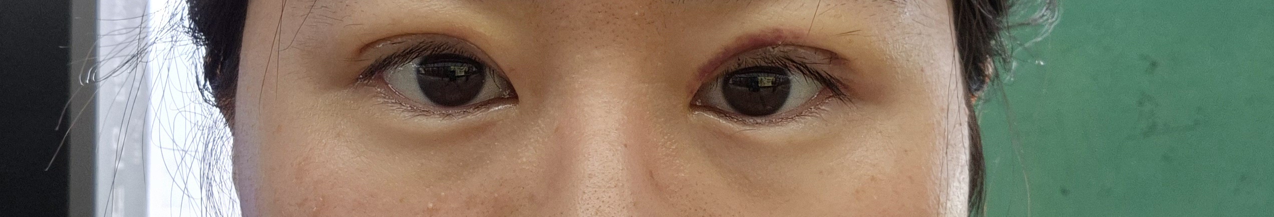 수술 직후사진. 왼쪽눈은 오늘 재수해서 붓기가 좀 있고 오른쪽 눈은 일주일간 붓기가 좀더 빠진 상태