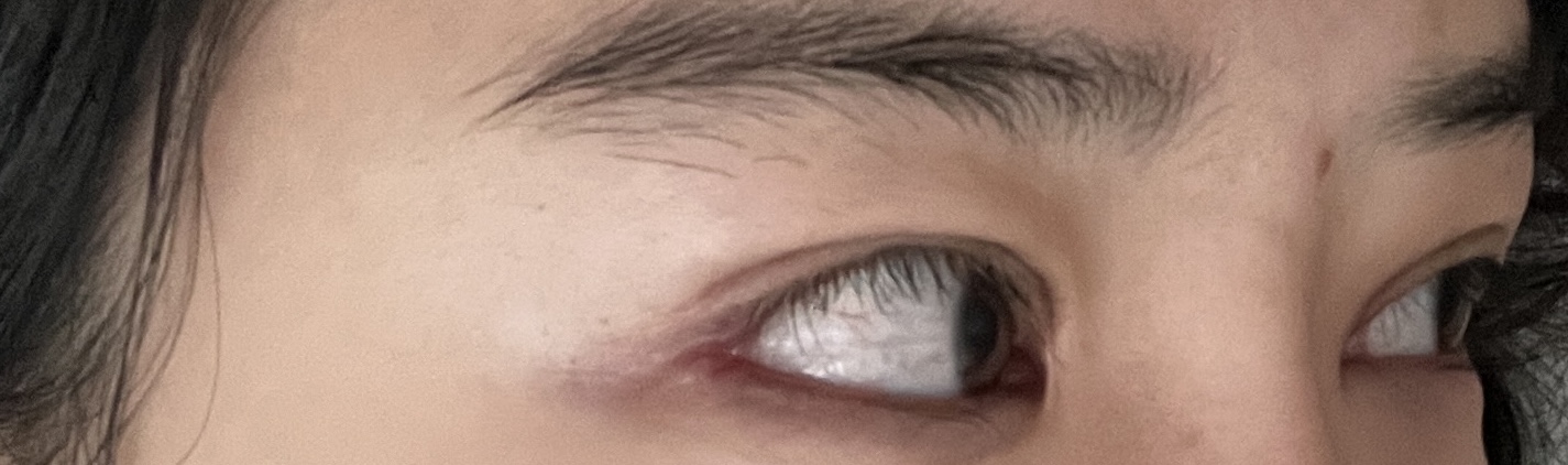 수술 후, 오른쪽 눈