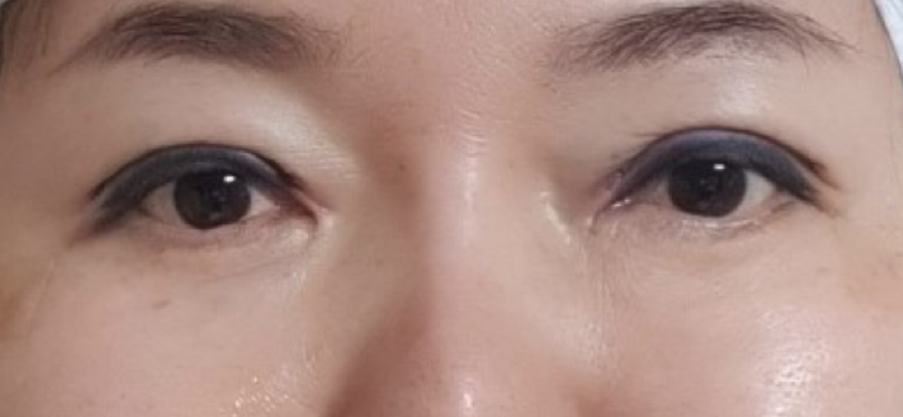 [수술당일] 눈재수술+눈매교정 사진