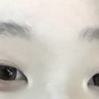 쌍수한지드디어1년반넘음
