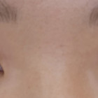 절개+눈매교정+앞트임 26일차 후기