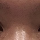 소시지눈? 재수술 후기