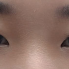 쌍수 절개+위트임 한달차후기