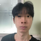 양윤돌구강악안면 턱끝 수술 4개월차