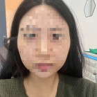 광대+지흡+심부볼제거 1년차 후기