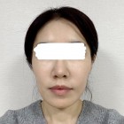 Review of facial contouring surgery for people in their 40s~ Big cheekbones, facial lines solved with 3 types (with swelling)