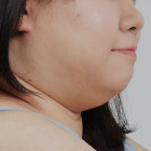 이중턱 지방추출주사 하고 6개월 찐후기!!