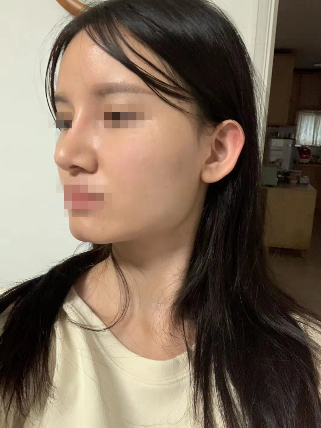 안면윤곽주사 후기 (부작용부터 1일차~7일차까지 경과 공유) 5