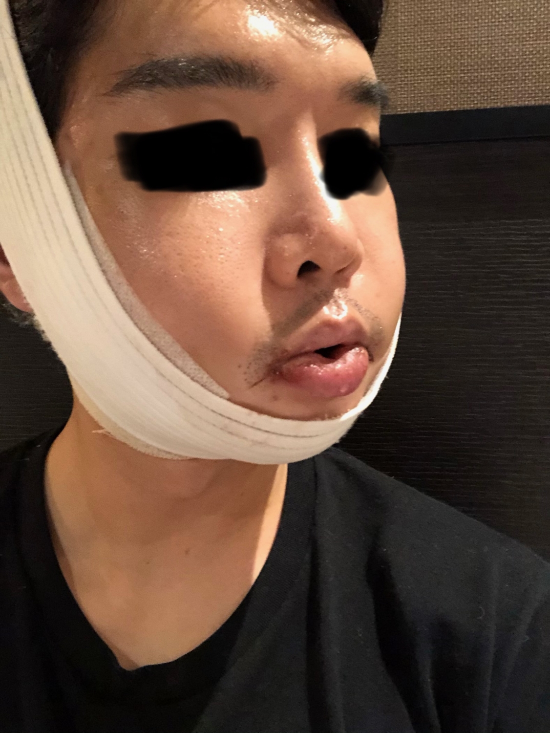 안면윤곽주사 후기 (부작용부터 1일차~7일차까지 경과 공유) 2