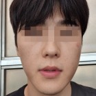 윤곽수술 (양악) 2개월차 후기 양악붓기 부정교합 …