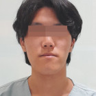 학창시절 부터 고민인 긴턱 양악 했어요