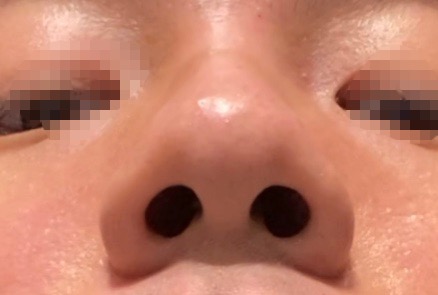 잠실 성형외과 후기