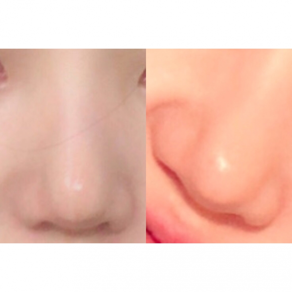 코재재수술 발품 상담 후기 + 코 사진, 병원 비추천