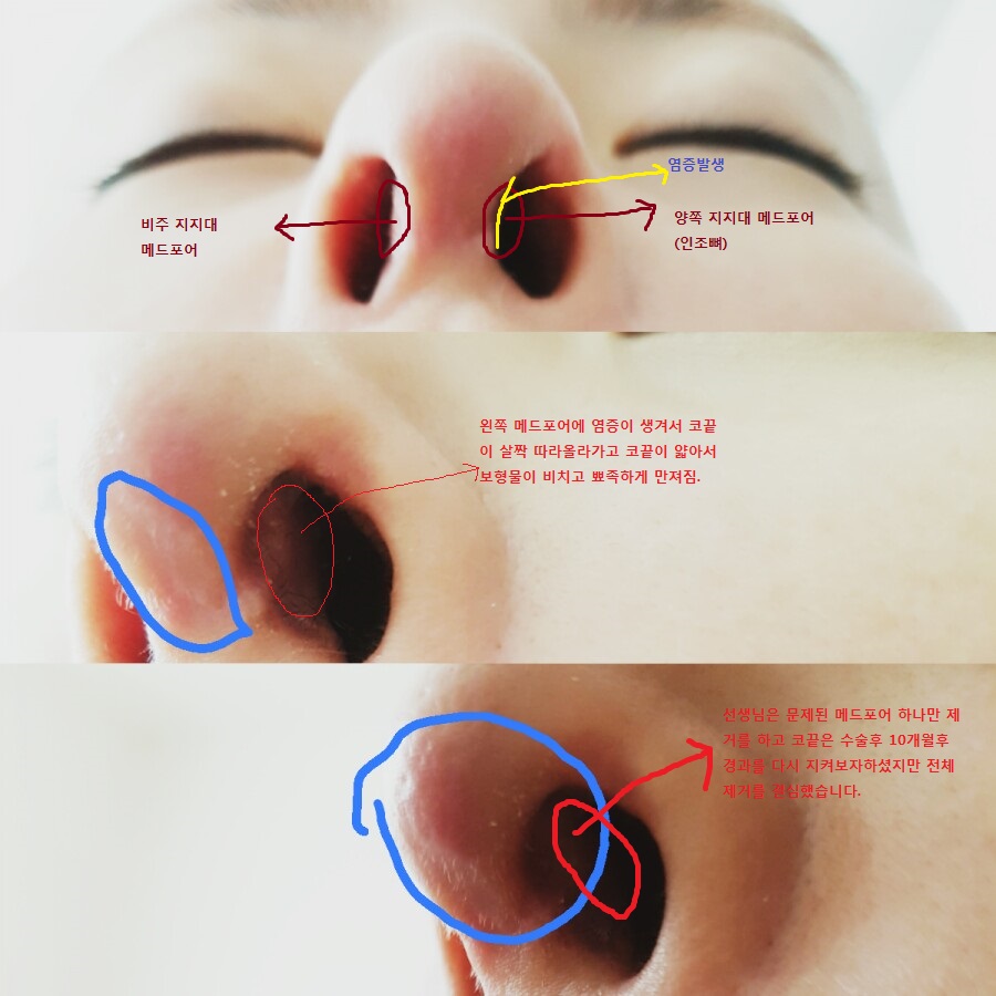 염증났던 부분이에요