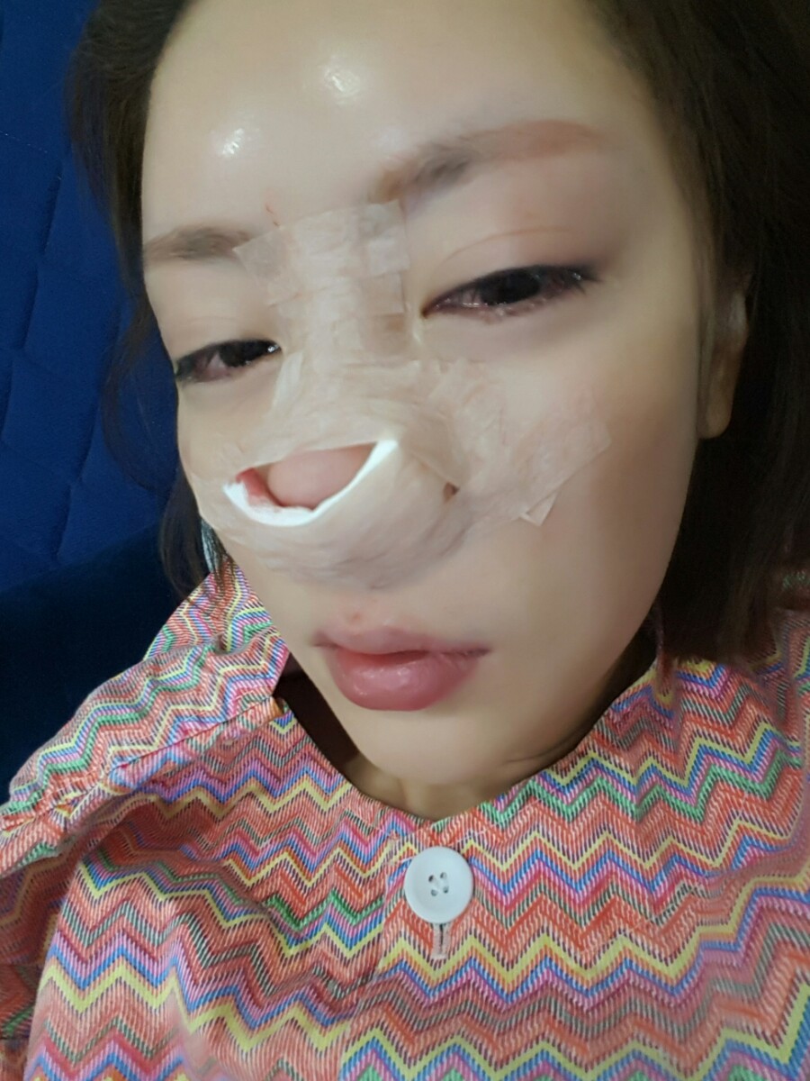 제거후 당일사진 