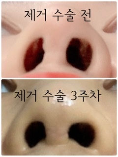 제거 전 후 콧구멍모양