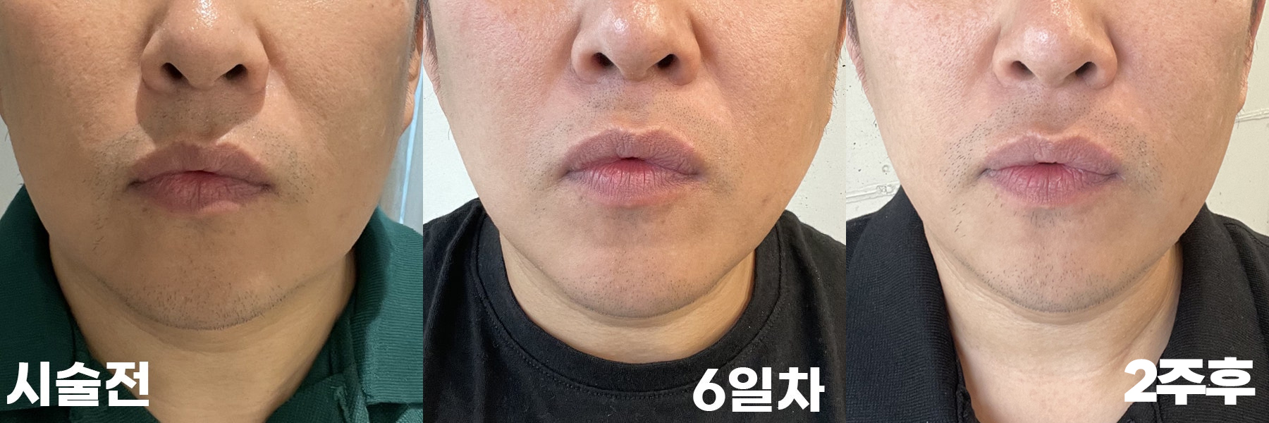 시술전과 6일에서 2주차 경과했을 때 비교